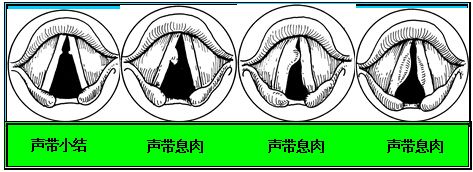 电子喉价格